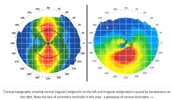 keratoconus-img-2-1