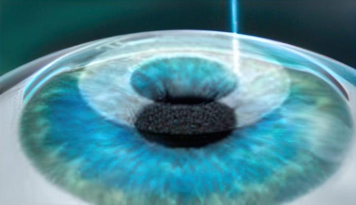 LASIK step 1