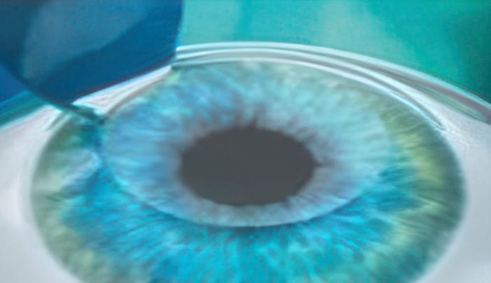 LASIK step 2