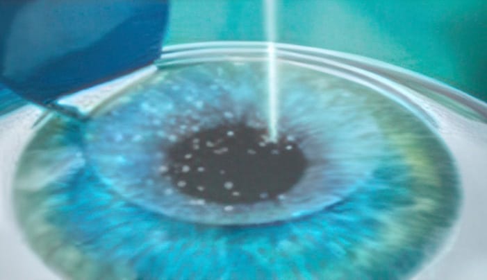 LASIK step 3